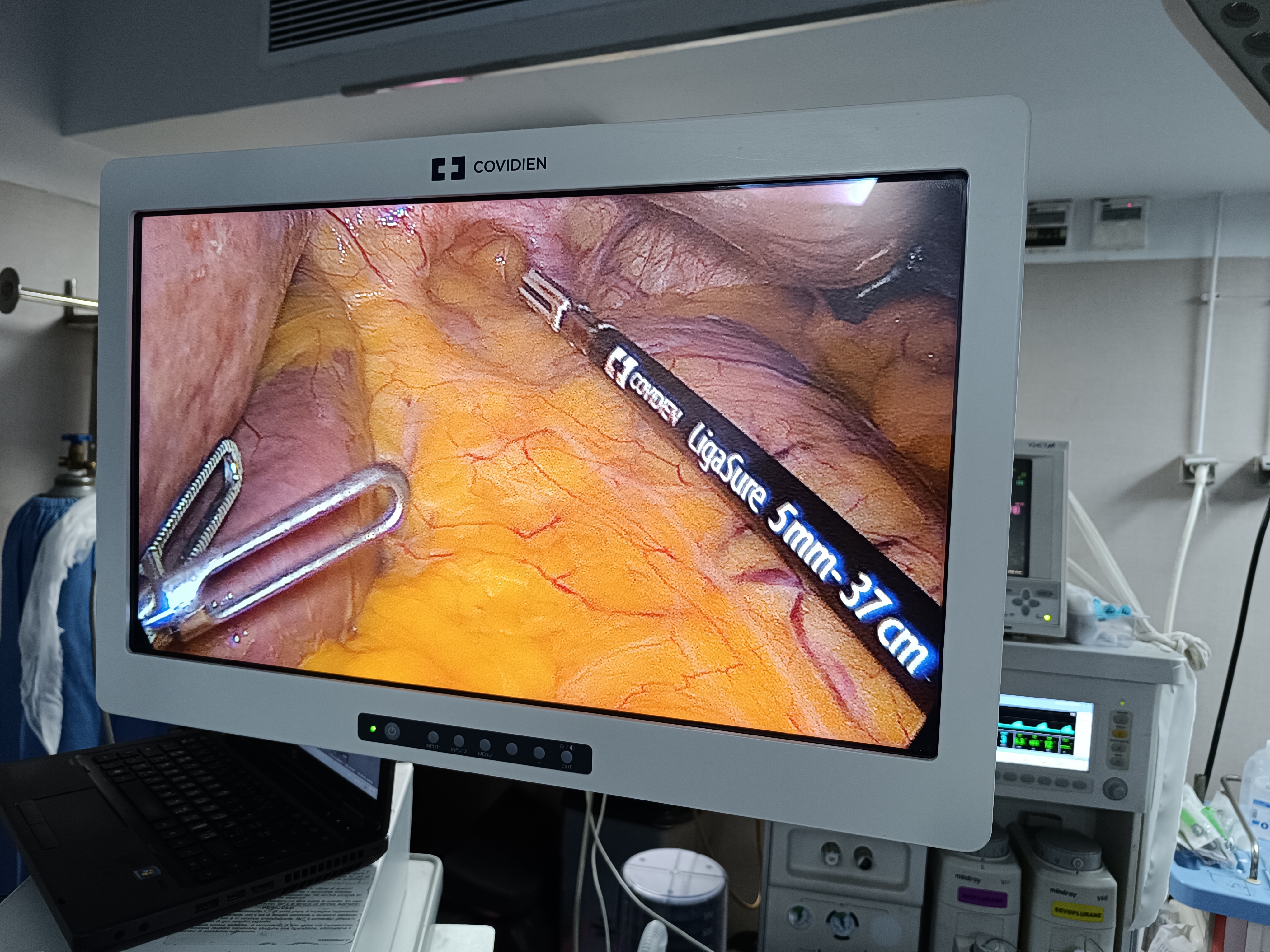 Hernia Surgery — Dr. Mohamed Abdelsalam Clinic